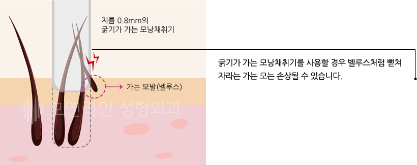 굵기가 가는 모낭채취기를 사용할 경우 벨루스처럼 뻗쳐 자라는 가는 모는 손상될 수 있습니다.