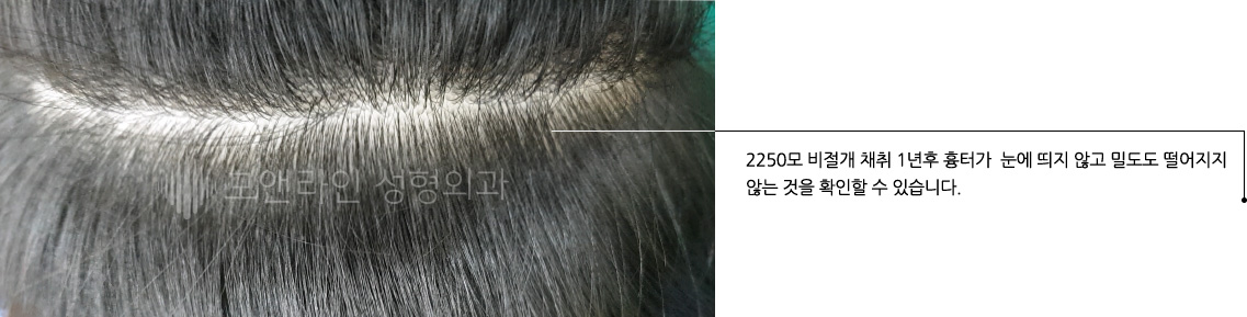 2250모 비절개 채취 1년후 흉터가  눈에 띄지 않고 밀도도 떨어지지 않는 것을 확인할 수 있습니다.