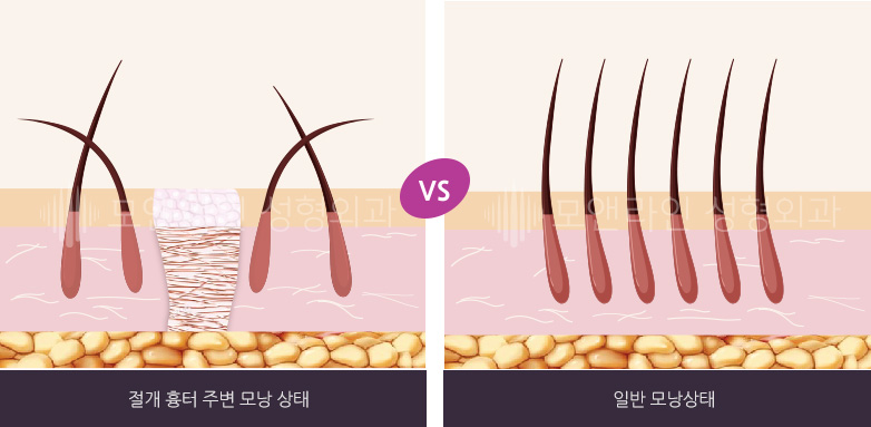 절개 흉터 주변 모낭 상태 VS 일반 모낭상태