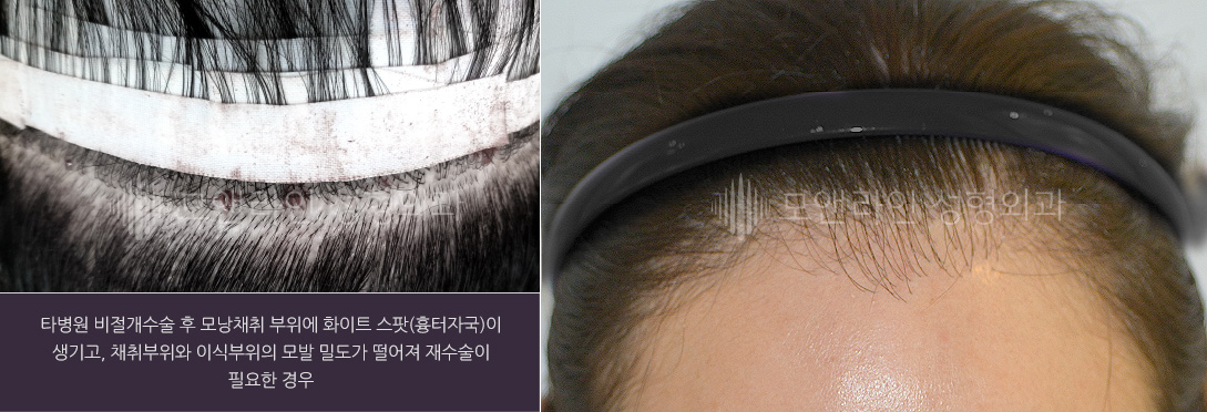 타병원 비절개수술 후 모낭채취 부위에 화이트 스팟(흉터자국)이 생기고, 채취부위와 이식부위의 모발 밀도가 떨어져 재수술이 필요한 경우
