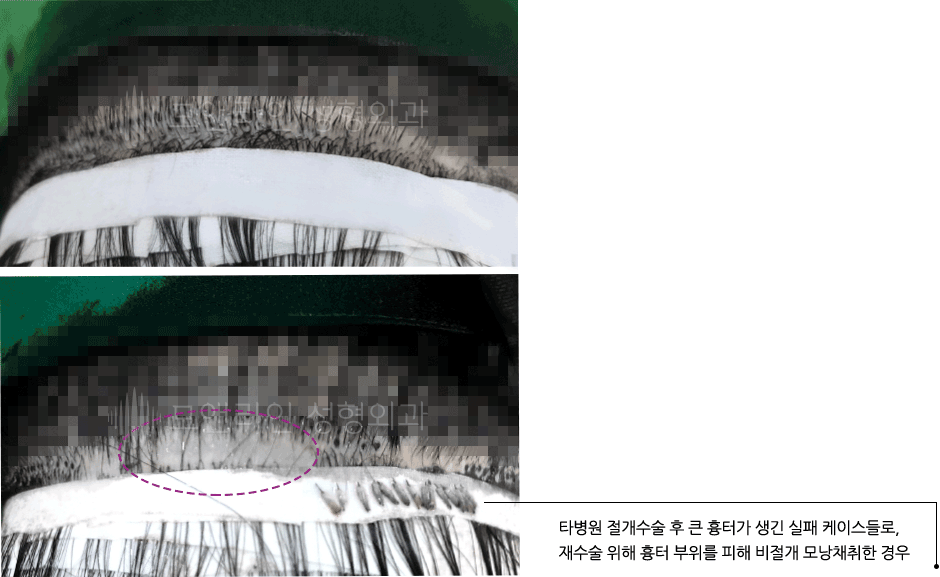 타병원 절개수술 후 큰 흉터가 생긴 실패 케이스들로, 재수술 위해 흉터 부위를 피해 비절개 모낭채취한 경우