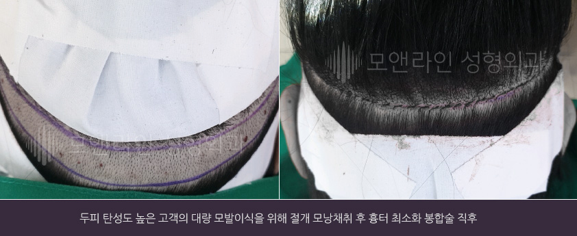 두피 탄성도 높은 고객의 대량 모발이식을 위해 절개 모낭채취 후 흉터 최소화 봉합술 직후
