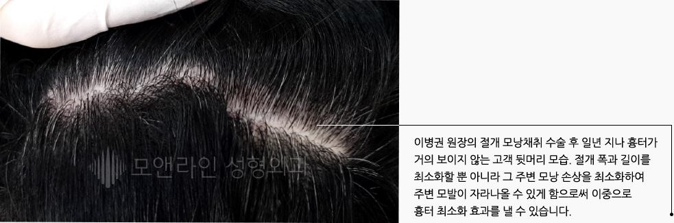 이병권 원장의 절개 모낭채취 수술 후 일년 지나 흉터가 거의 보이지 않는 고객 뒷머리 모습. 절개 폭과 길이를 최소화할 뿐 아니라 그 주변 모낭 손상을 최소화하여 주변 모발이 자라나올 수 있게 함으로써 이중으로 흉터 최소화 효과를 낼 수 있습니다.