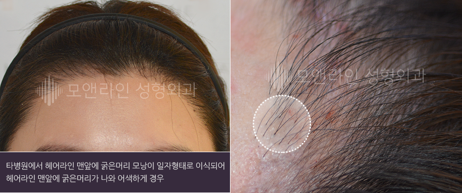 헤어라인 맨앞에 굵은머리 모낭이 굴곡 없이 일자형태로 이식되어 헤어라인 맨앞에 굵은머리가 나와 어색하게 경우