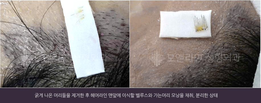 굵게 나온 머리들을 제거한 후 헤어라인 맨앞에 이식할 벨루스와 가는머리 모낭을 채취, 분리한 상태