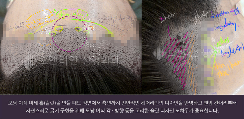 모낭 이식 미세 홀(슬릿)을 만들 때도 정면에서 측면까지 전반적인 헤어라인의 디자인을 반영하고 맨앞 잔머리부터 자연스러운 굵기 구현을 위해 모낭 이식 각 · 방향 등을 고려한 슬릿 디자인 노하우가 중요합니다.