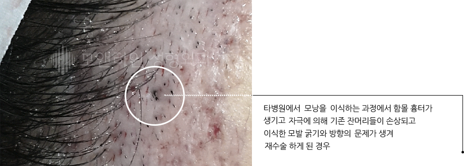 타병원에서 모낭을 이식하는 과정에서 함몰 흉터가 생기고 자극에 의해 기존 잔머리들이 손상되고 이식한 모발 굵기와 방향의 문제가 생겨 재수술 하게 된 경우
