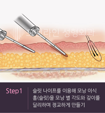 Step1. 슬릿 나이프를 이용해 모낭 이식 홀(슬릿)을 모낭 별 각도와 깊이를 달리하며 정교하게 만들기