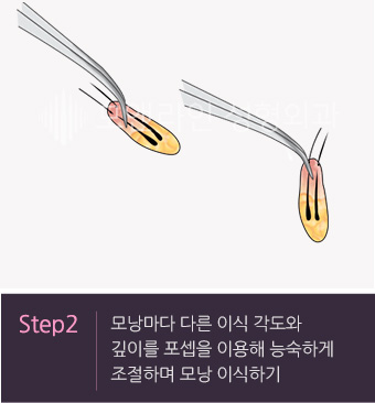 Step2. 모낭마다 다른 이식 각도와 깊이를 포셉을 이용해 능숙하게 조절하며 모낭 이식하기