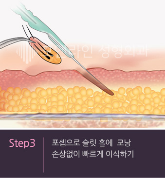 Step3. 포셉으로 슬릿 홀에  모낭 손상없이 빠르게 이식하기