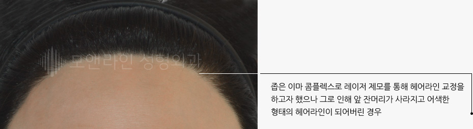 좁은 이마 콤플렉스로 레이저 제모를 통해 헤어라인 교정을 하고자 했으나 그로 인해 앞 잔머리가 사라지고 어색한 형태의 헤어라인이 되어버린 경우