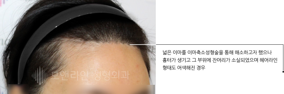 넓은 이마를 이마축소성형술을 통해 해소하고자 했으나 흉터가 생기고 그 부위에 잔머리가 소실되었으며 헤어라인 형태도 어색해진 경우