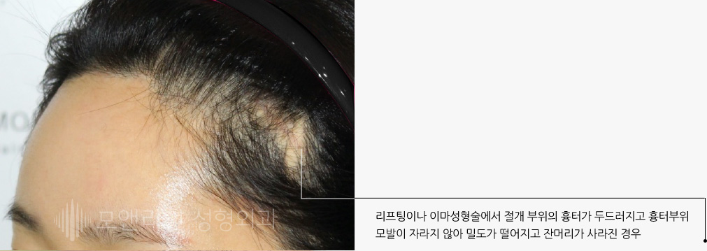 리프팅이나 이마성형술에서 절개 부위의 흉터가 두드러지고 흉터부위 모발이 자라지 않아 밀도가 떨어지고 잔머리가 사라진 경우