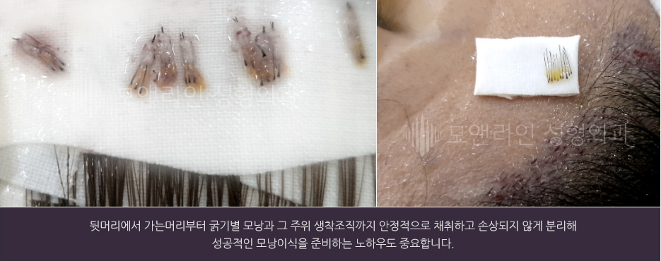 뒷머리에서 가는머리부터 굵기별 모낭과 그 주위 생착조직까지 안정적으로 채취하고 손상되지 않게 분리해 성공적인 모낭이식을 준비하는 노하우도 중요합니다.