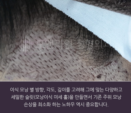 이식 모낭 별 방향, 각도, 깊이를 고려해 그에 맞는 다양하고 세밀한 슬릿(모낭이식 미세 홀)을 만들면서 기존 주위 모낭 손상을 최소화 하는 노하우 역시 중요합니다.