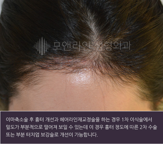 이마축소술 후 흉터 개선과 헤어라인재교정술을 하는 경우 1차 이식술에서 밀도가 부분적으로 떨어져 보일 수 있는데 이 경우 흉터 정도에 따른 2차 수술 또는 부분 터치업 보강술로 개선이 가능합니다.