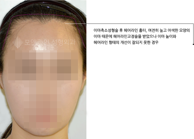 이마축소성형술 후 헤어라인 흉터, 여전히 높고 어색한 모양의 이마 때문에 헤어라인교정술을 받았으나 이마 높이와 헤어라인 형태의 개선이 잘되지 못한 경우