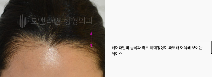 헤어라인의 굴곡과 좌우 비대칭성이 과도해 어색해 보이는 케이스