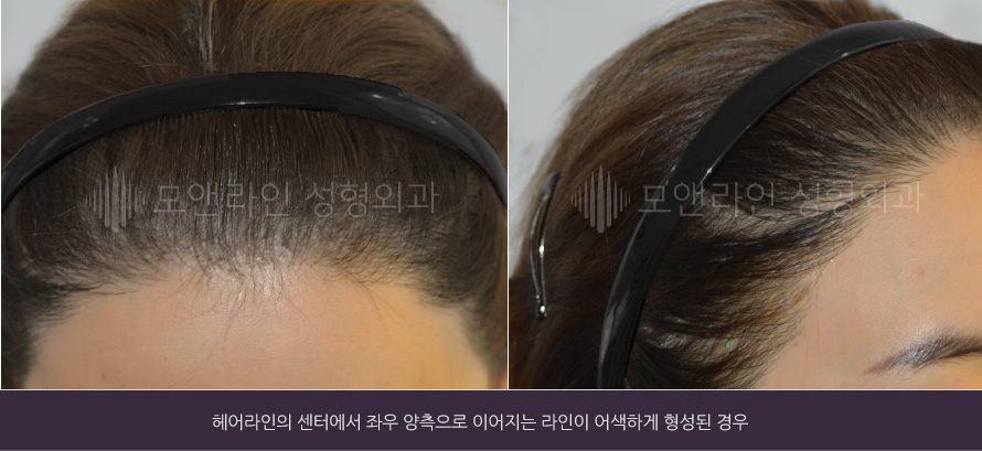 헤어라인의 센터에서 좌우 양측으로 이어지는 라인이 어색하게 형성된 경우