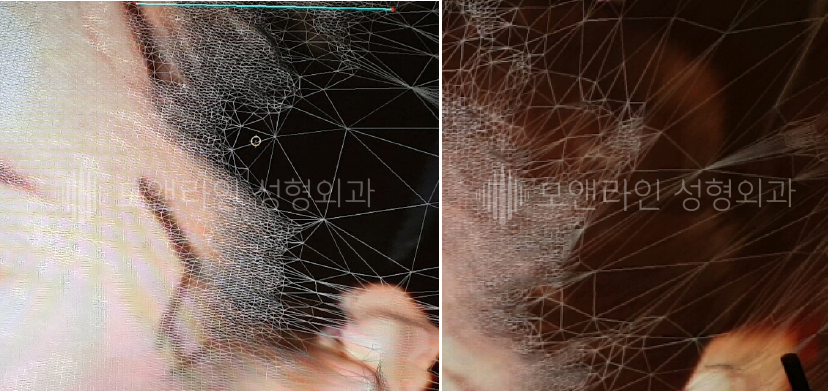 이마축소성형술 후 헤어라인 흉터, 여전히 높고 어색한 모양의 이마 때문에 헤어라인교정술을 받았으나 이마 높이와 헤어라인 형태의 개선이 잘되지 못한 경우