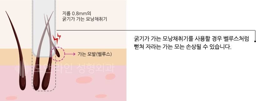 굵기가 가는 모낭채취기를 사용할 경우 벨루스처럼 뻗쳐 자라는 가는 모는 손상될 수 있습니다.