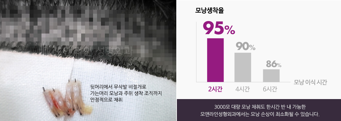 3000모 대량 모낭 채취도 한시간 반 내 가능한 모앤라인성형외과에서는 모낭 손상이 최소화될 수 있습니다.