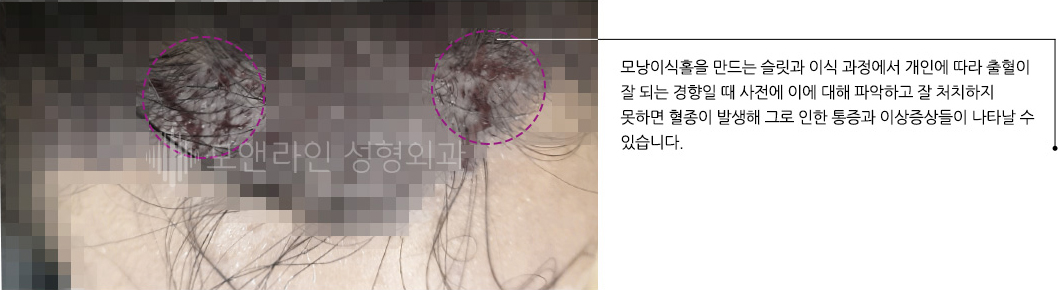 모낭이식홀을 만드는 슬릿과 이식 과정에서 개인에 따라 출혈이 잘 되는 경향일 때 사전에 이에 대해 파악하고 잘 처치하지 못하면 혈종이 발생해 그로 인한 통증과 이상증상들이 나타날 수 있습니다.