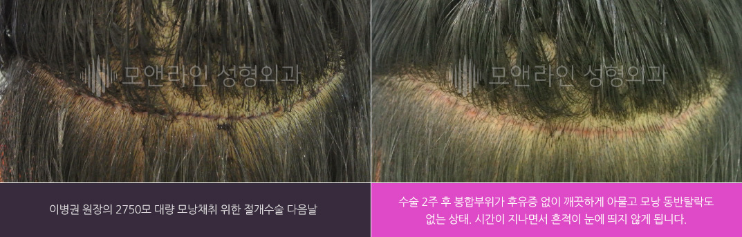 이병권 원장의 2750모 대량 모낭채취 위한 절개수술 다음날 / 수술 2주 후 봉합부위가 후유증 없이 깨끗하게 아물고 모낭 동반탈락도 없는 상태. 시간이 지나면서 흔적이 눈에 띄지 않게 됩니다.