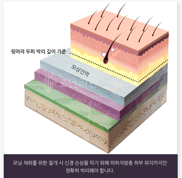 모낭 채취를 위한 절개 시 신경 손상을 막기 위해 피하지방층 하부 위치까지만 정확히 박리해야 합니다.