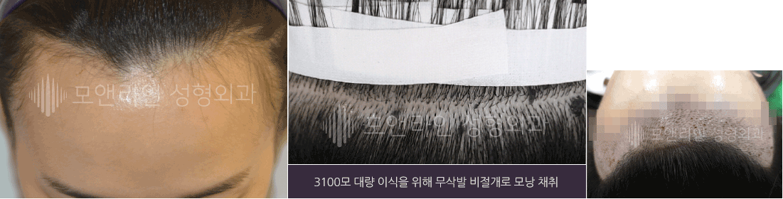 3100모 대량 이식을 위해 무삭발 비절개로 모낭 채취