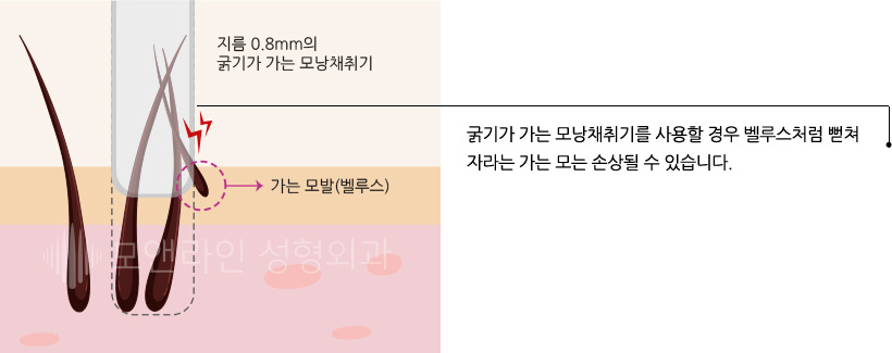 굵기가 가는 모낭채취기를 사용할 경우 벨루스처럼 뻗쳐 자라는 가는 모는 손상될 수 있습니다.