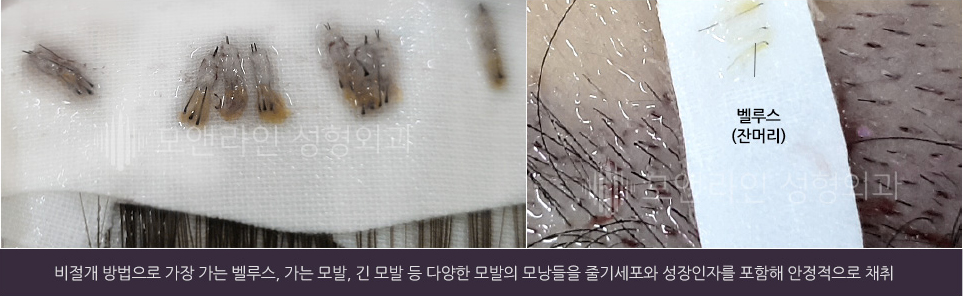 비절개 방법으로 가장 가는 벨루스, 가는 모발, 긴 모발 등 다양한 모발의 모낭들을 줄기세포와 성장인자를 포함해 안정적으로 채취