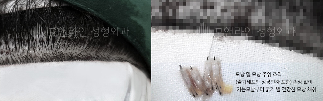 모낭 및 모낭 주위 조직(줄기세포와 성장인자 포함) 손상 없이 가는모발부터 굵기 별 건강한 모낭 채취