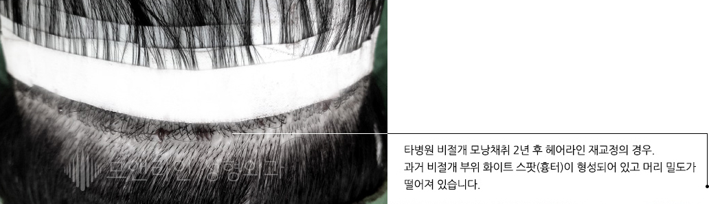 타병원 비절개 모낭채취 2년 후 헤어라인 재교정의 경우. 과거 비절개 부위 화이트 스팟(흉터)이 형성되어 있고 머리 밀도가 떨어져 있습니다.