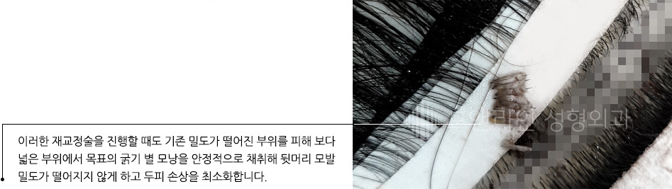 이러한 재교정술을 진행할 때도 기존 밀도가 떨어진 부위를 피해 보다 넓은 부위에서 목표의 굵기 별 모낭을 안정적으로 채취해 뒷머리 모발 밀도가 떨어지지 않게 하고 두피 손상을 최소화합니다.