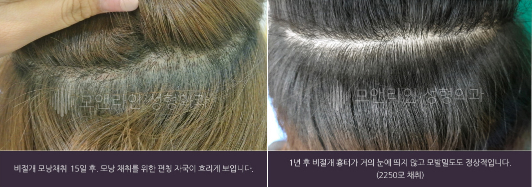 비절개 모낭채취 15일 후. 모낭 채취를 위한 펀칭 자국이 흐리게 보입니다. / 1년 후 비절개 흉터가 거의 눈에 띄지 않고 모발밀도도 정상적입니다.(2250모 채취)