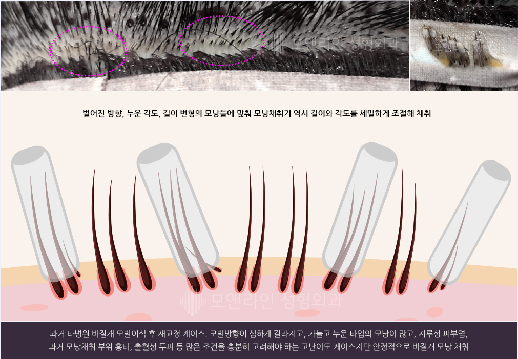 과거 타병원 비절개 모발이식 후 재교정 케이스. 모발방향이 심하게 갈라지고, 가늘고 누운 타입의 모낭이 많고, 지루성 피부염, 과거 모낭채취 부위 흉터, 출혈성 두피 등 많은 조건을 충분히 고려해야 하는 고난이도 케이스지만 안정적으로 비절개 모낭 채취
