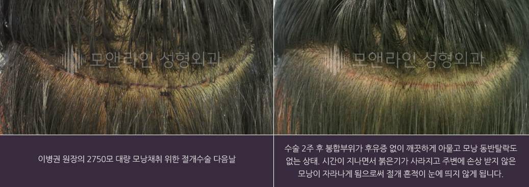 이병권 원장의 2750모 대량 모낭채취 위한 절개수술 다음날 / 수술 2주 후 봉합부위가 후유증 없이 깨끗하게 아물고 모낭 동반탈락도 없는 상태. 시간이 지나면서 붉은기가 사라지고 주변에 손상 받지 않은 모낭이 자라나게 됨으로써 절개 흔적이 눈에 띄지 않게 됩니다.