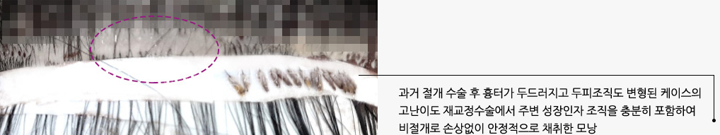 과거 절개 수술 후 흉터가 두드러지고 두피조직도 변형된 케이스의 고난이도 재교정수술에서 주변 성장인자 조직을 충분히 포함하여 비절개로 손상없이 안정적으로 채취한 모낭