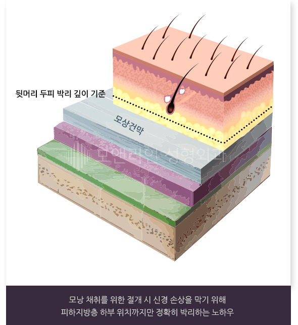 모낭 채취를 위한 절개 시 신경 손상을 막기 위해 피하지방층 하부 위치까지만 정확히 박리하는 노하우