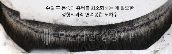 수술 후 통증과 흉터를 최소화하는 데 필요한 성형외과적 연속봉합 노하우