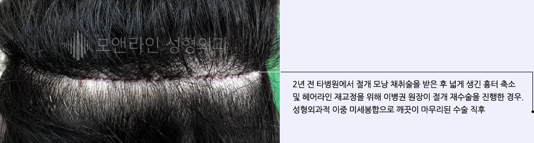 2년 전 타병원에서 절개 모낭 채취술을 받은 후 넓게 생긴 흉터 축소 및 헤어라인 재교정을 위해 이병권 원장이 절개 재수술을 진행한 경우. 성형외과적 이중 미세봉합으로 깨끗이 마무리된 수술 직후
