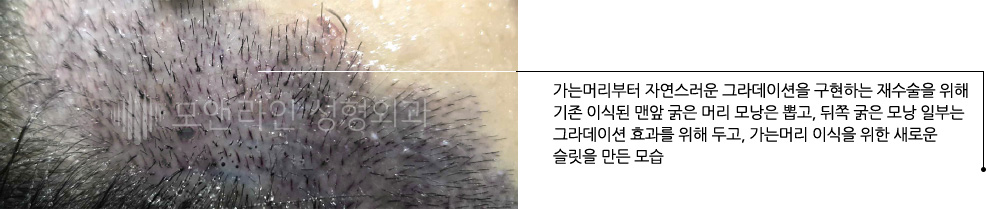가는머리부터 자연스러운 그라데이션을 구현하는 재수술을 위해 기존 이식된 맨앞 굵은 머리 모낭은 뽑고, 뒤쪽 굵은 모낭 일부는 그라데이션 효과를 위해 두고, 가는머리 이식을 위한 새로운 슬릿을 만든 모습