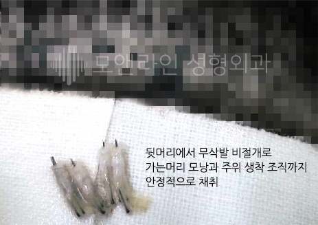 뒷머리에서 무삭발 비절개로 가는머리 모낭과 주위 생착 조직까지 안정적으로 채취