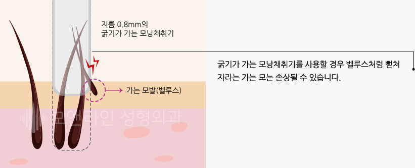 굵기가 가는 모낭채취기를 사용할 경우 벨루스처럼 뻗쳐 자라는 가는 모는 손상될 수 있습니다.