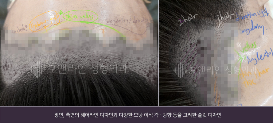 정면, 측면의 헤어라인 디자인과 다양한 모낭 이식 각 · 방향 등을 고려한 슬릿 디자인