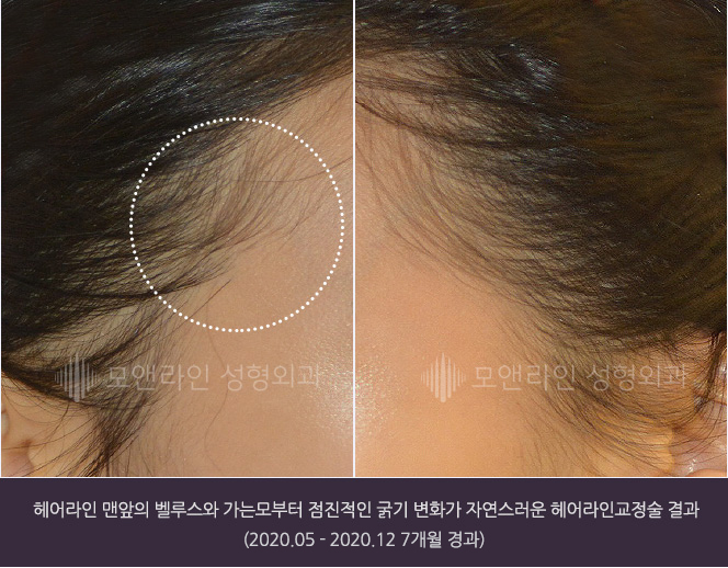 헤어라인 맨앞의 벨루스와 가는모부터 점진적인 굵기 변화가 자연스러운 헤어라인교정술 결과(2020.05-2020.12 7개월 경과)