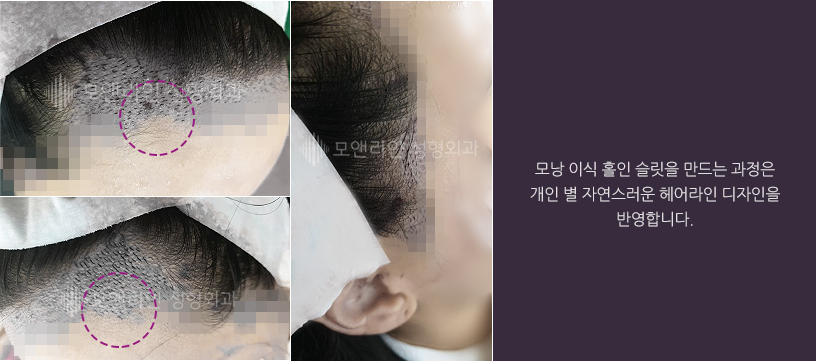 모낭 이식 홀인 슬릿을 만드는 과정은 개인 별 자연스러운 헤어라인 디자인을 반영합니다.
