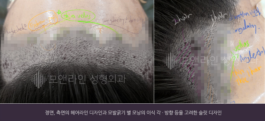 정면, 측면의 헤어라인 디자인과 모발굵기 별 모낭의 이식 각 · 방향 등을 고려한 슬릿 디자인