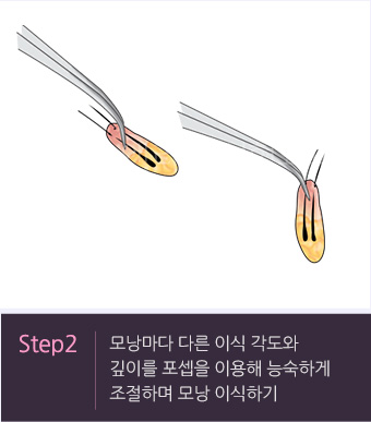 Step2. 모낭마다 다른 이식 각도와 깊이를 포셉을 이용해 능숙하게 조절하며 모낭 이식하기